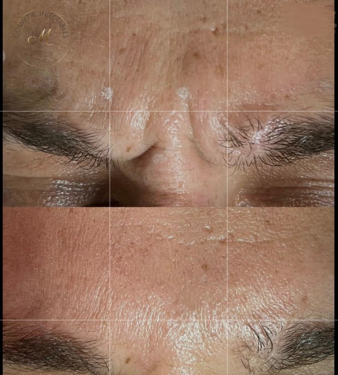 before and after anti-wrinkle