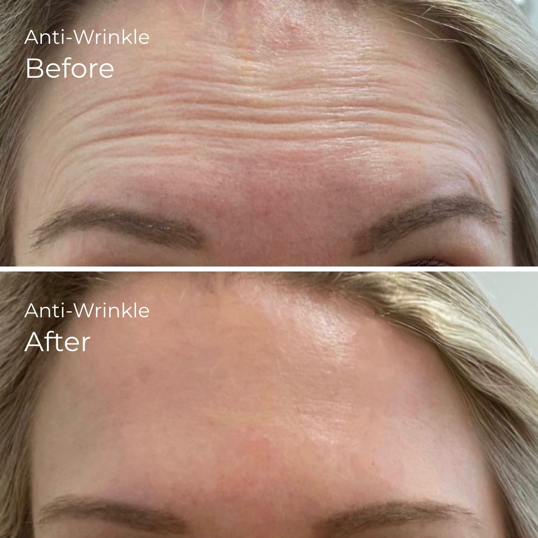 before and after anti-wrinkle