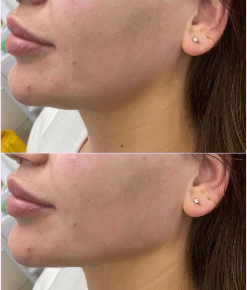 before and after dermal filler injectables