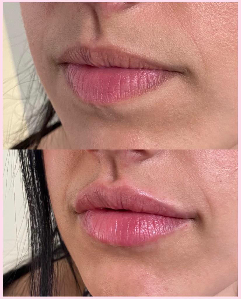 before and after derma filler injectables