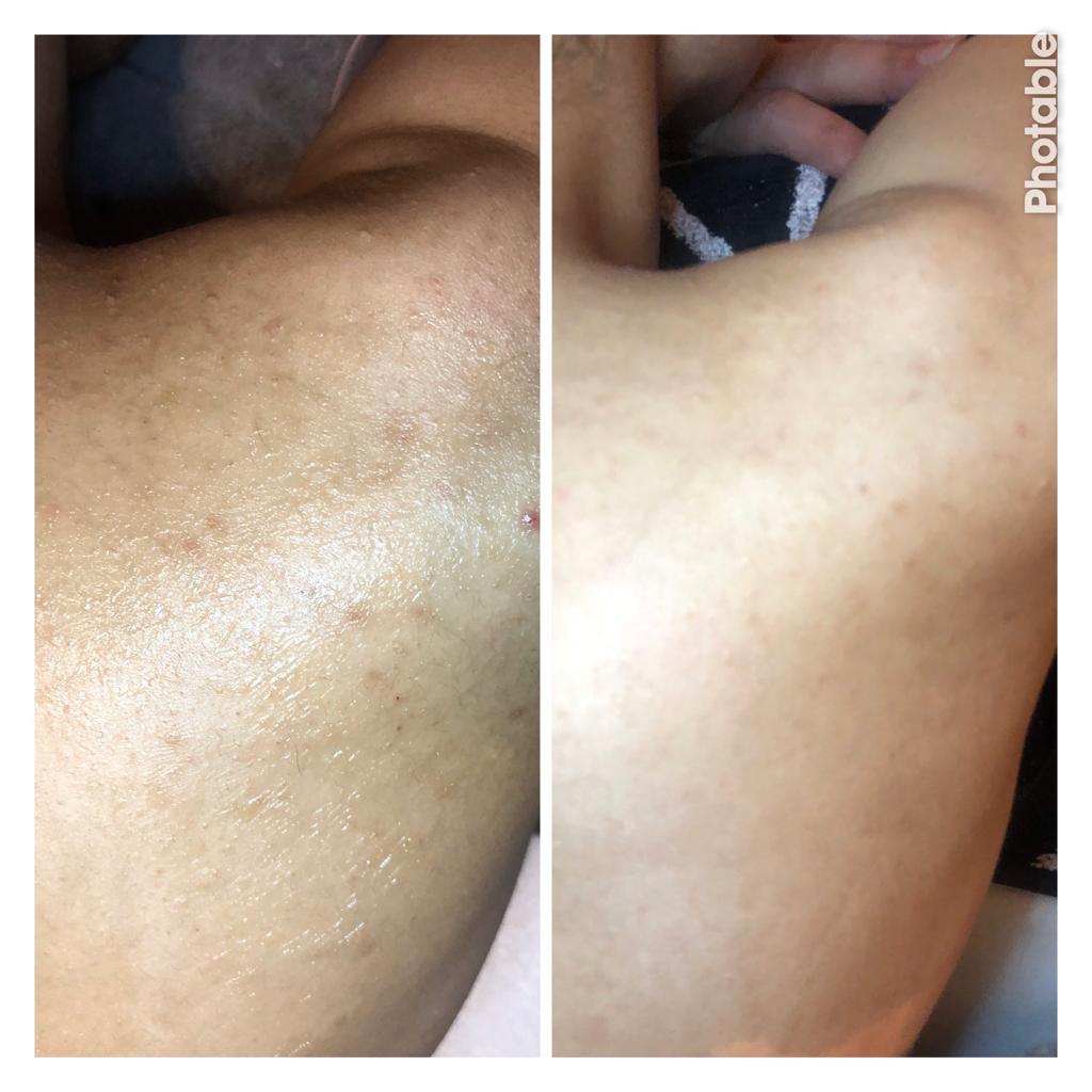 Dermapen skin needling before and after