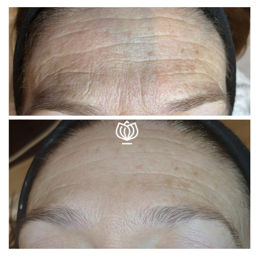before and after enzyme therapy mask