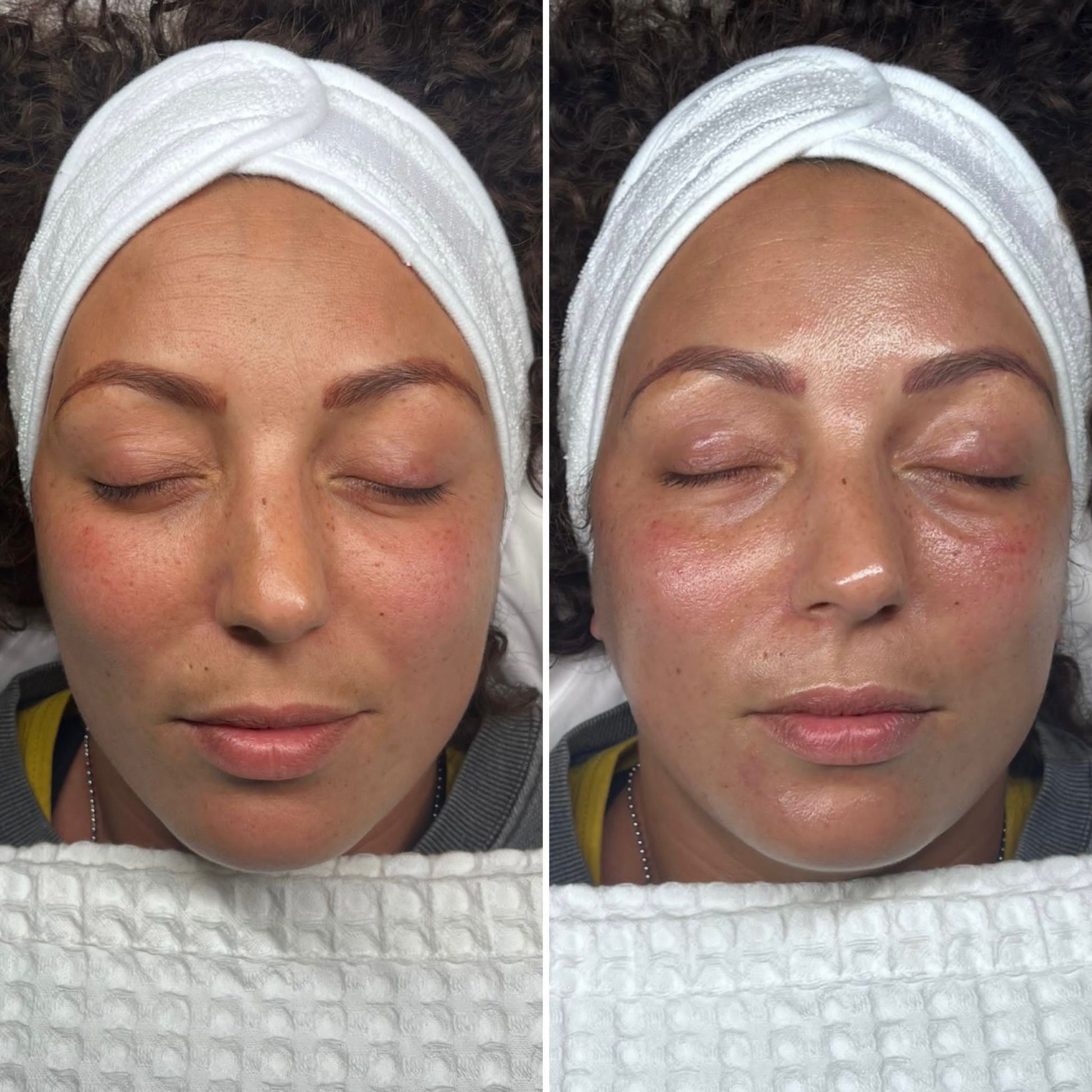 hydrafacial before & after skin treatment (hydrate, glow, fire & ice)