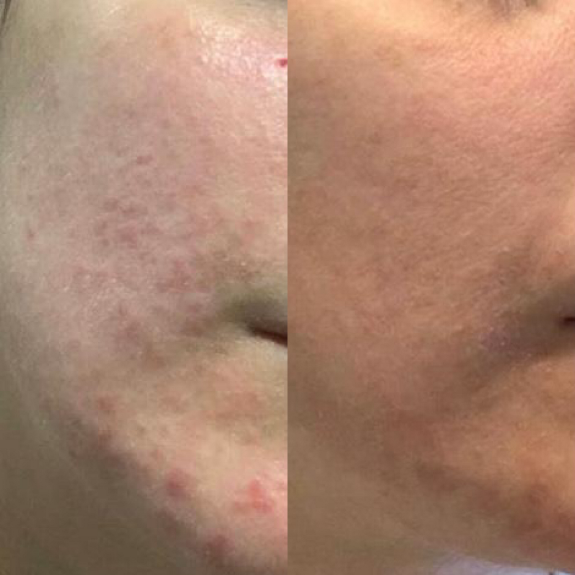 before and after LED light therapy 
