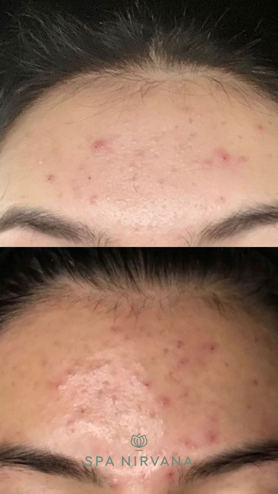 microdermabrasion before and after skin treatment