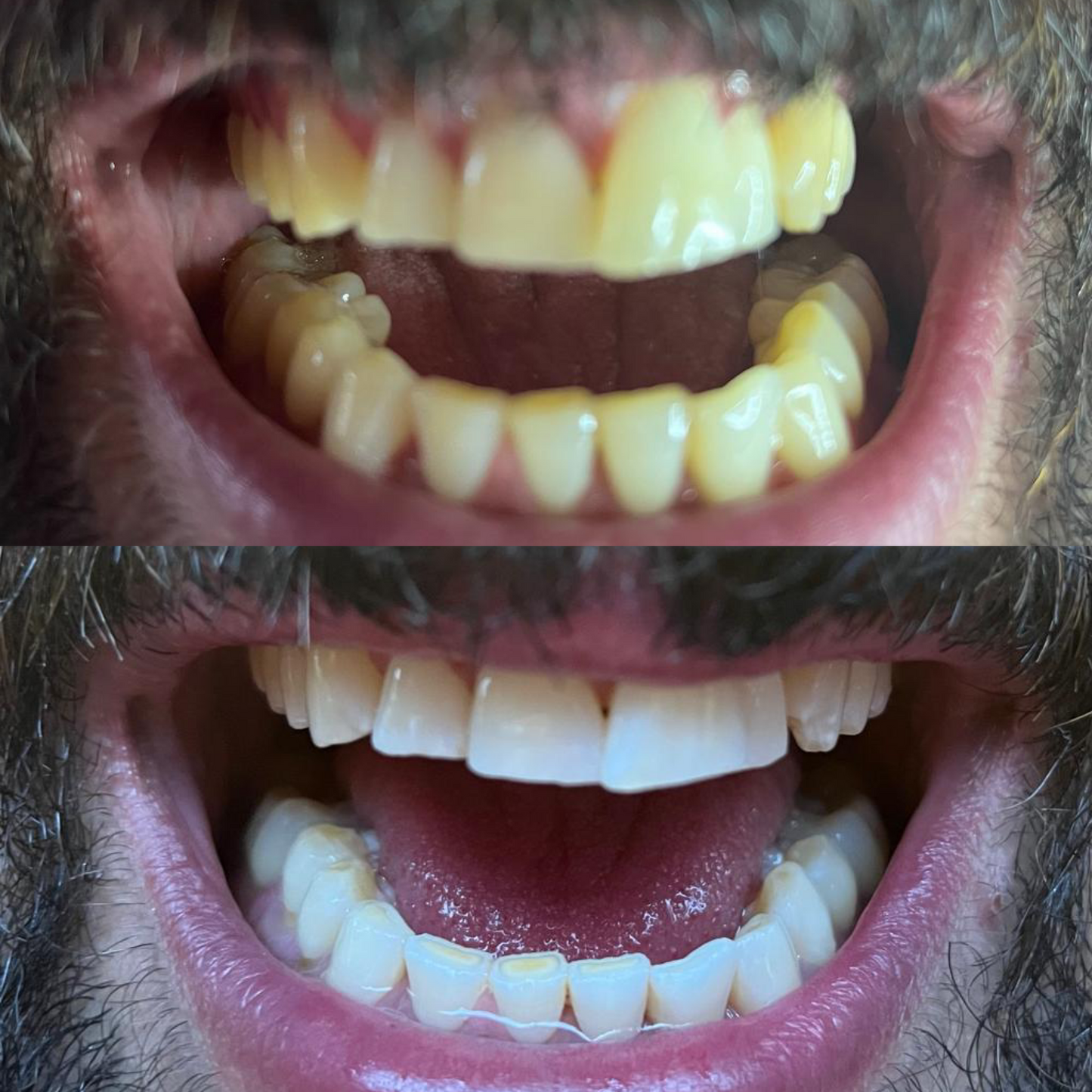 before and after natural teeth whitening