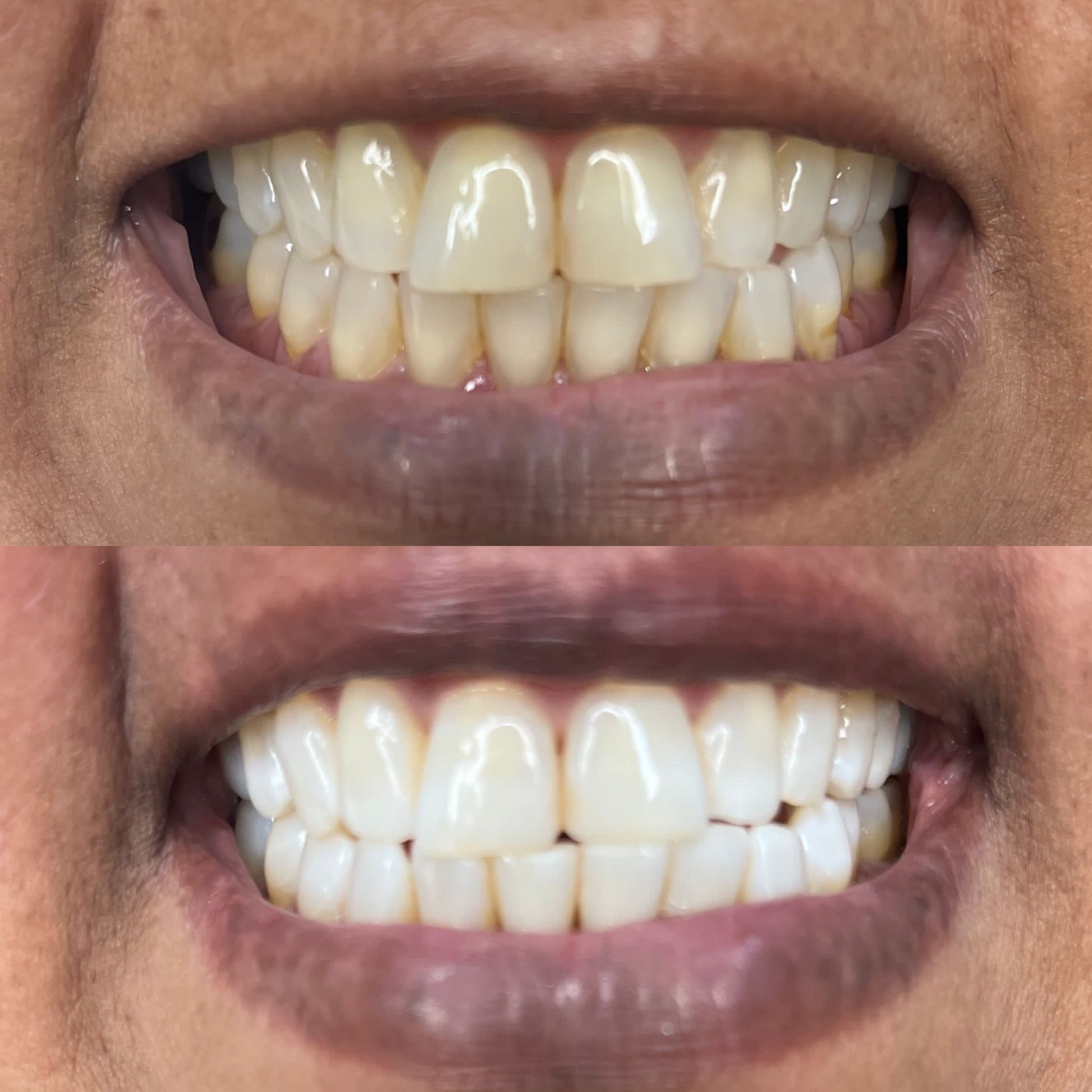 before and after natural whitening