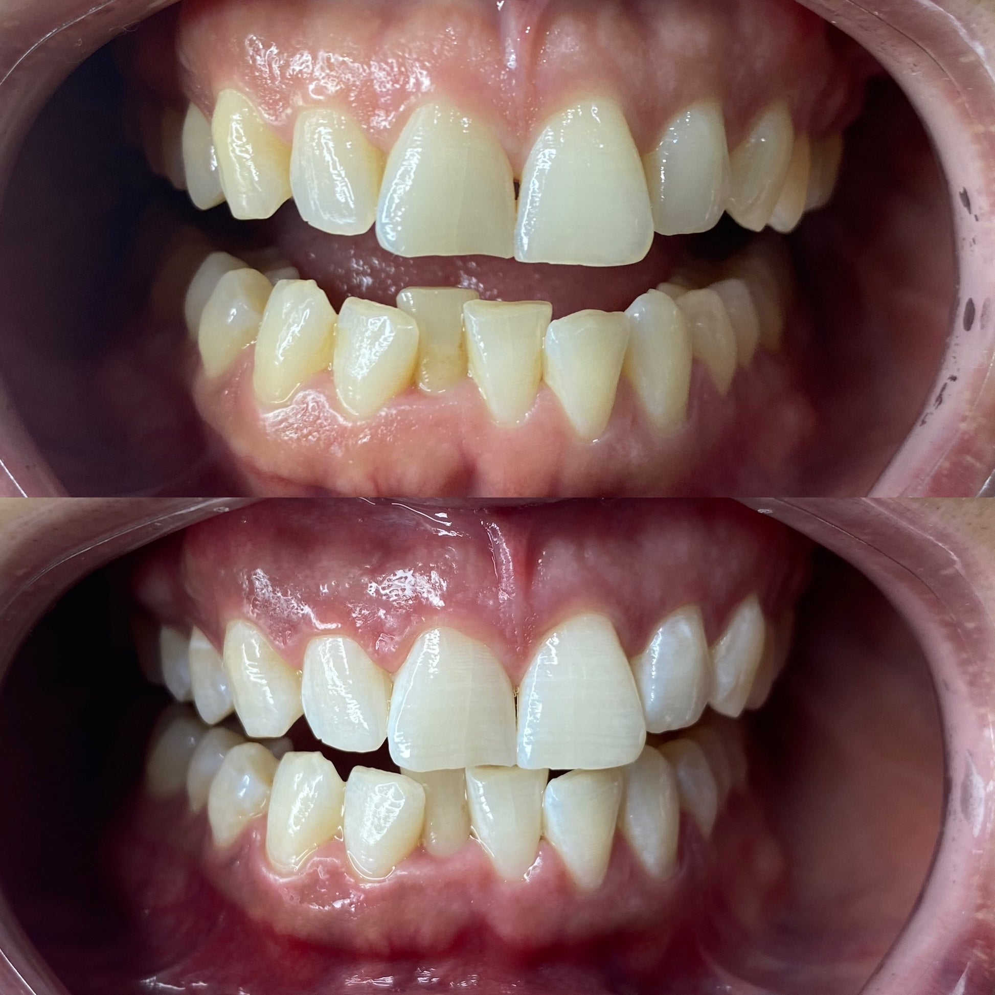 before and after peroxide teeth whitening