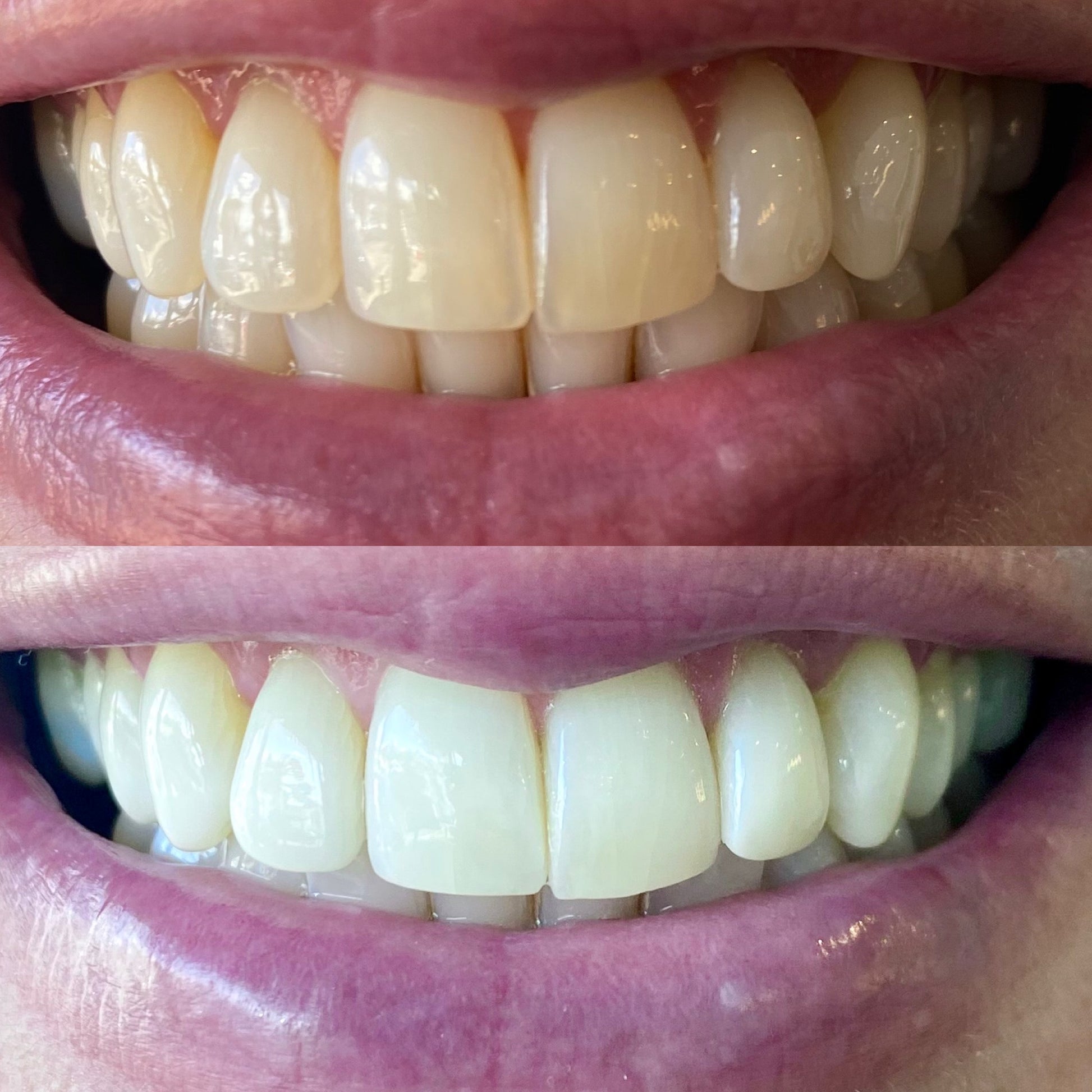 before and after peroxide teeth whitening