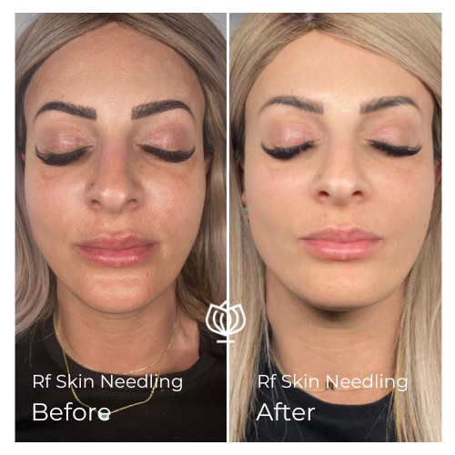 before and after rf skin needling