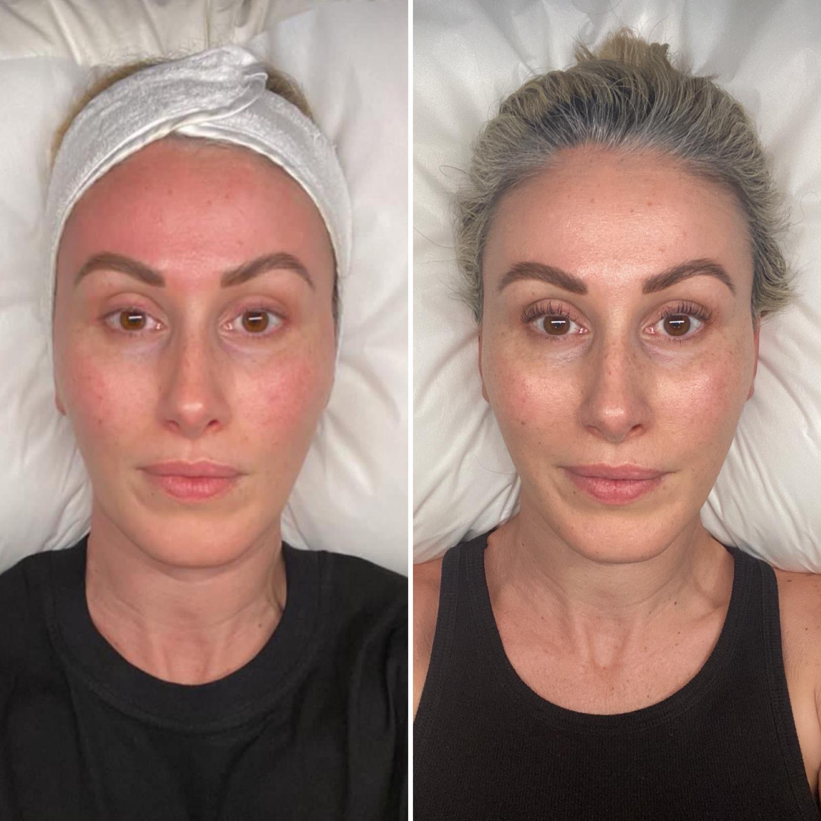 before and after sylfirm x rf skin needling
