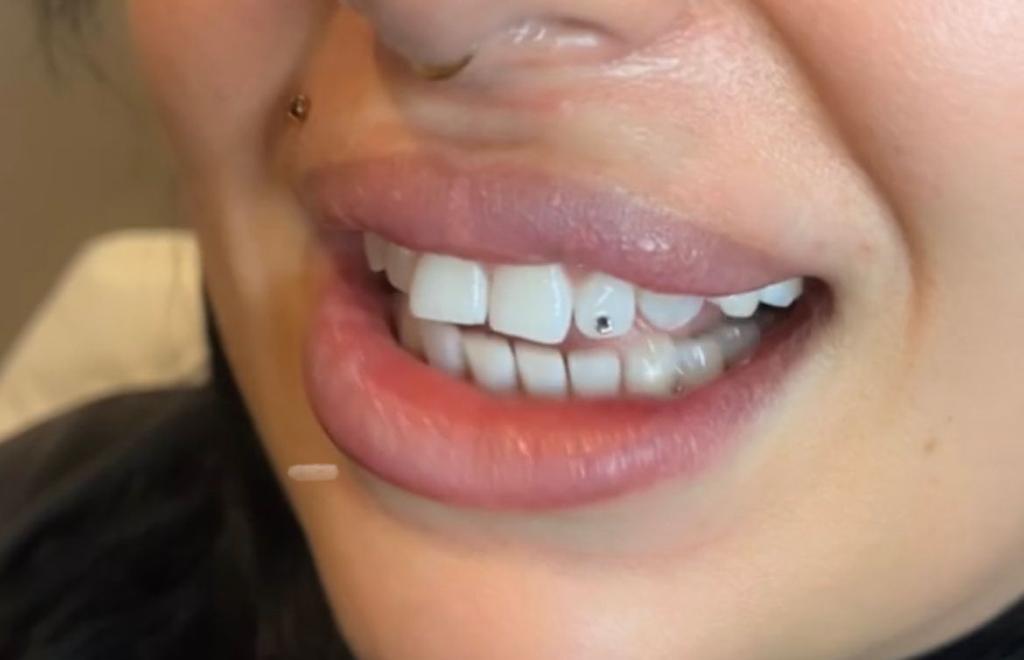 teeth whitening information