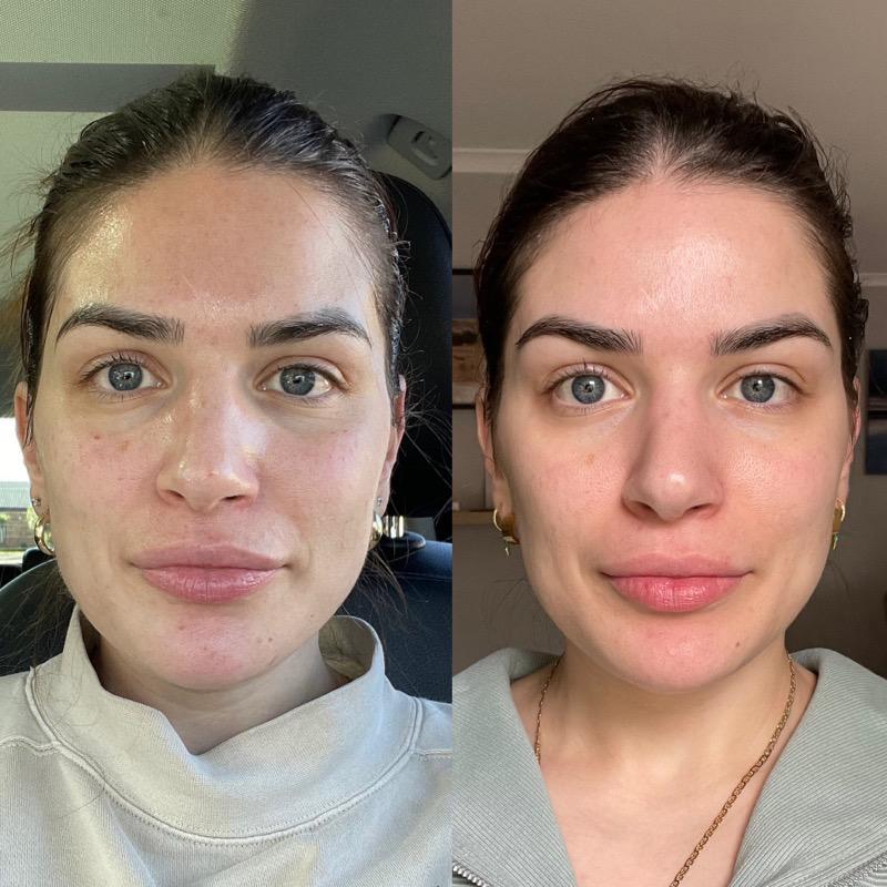 before and after v2 skin booster