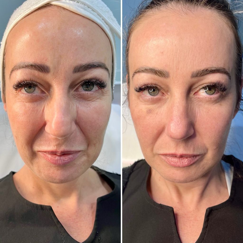 before and after v2 skin booster